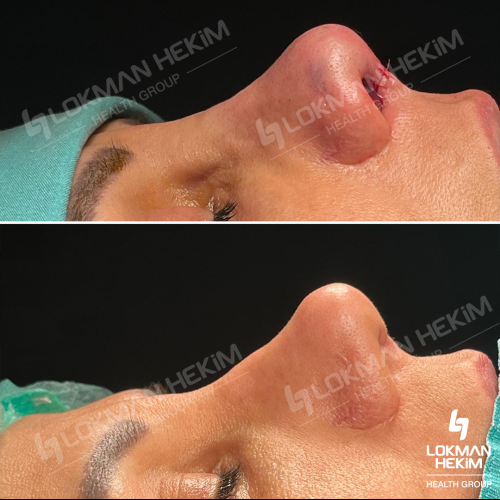 Septoplasty Before / After photo